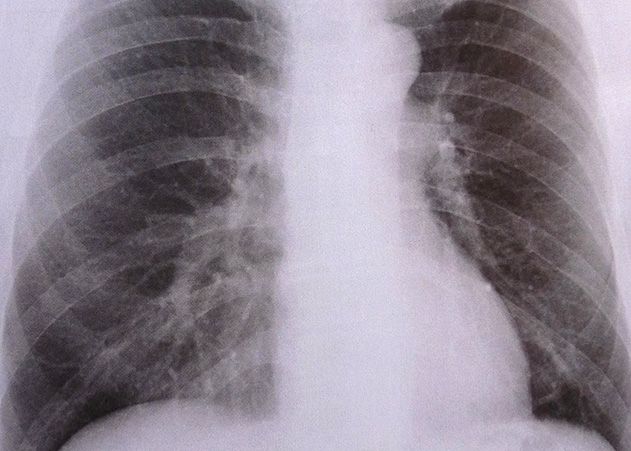 Bei einem Kind in Jena wurde Lungentuberkulose diagnostiziert.