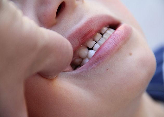 Studie am Uniklinikum Jena: Können Zahnärzte Kindesmisshandlungen erkennen?